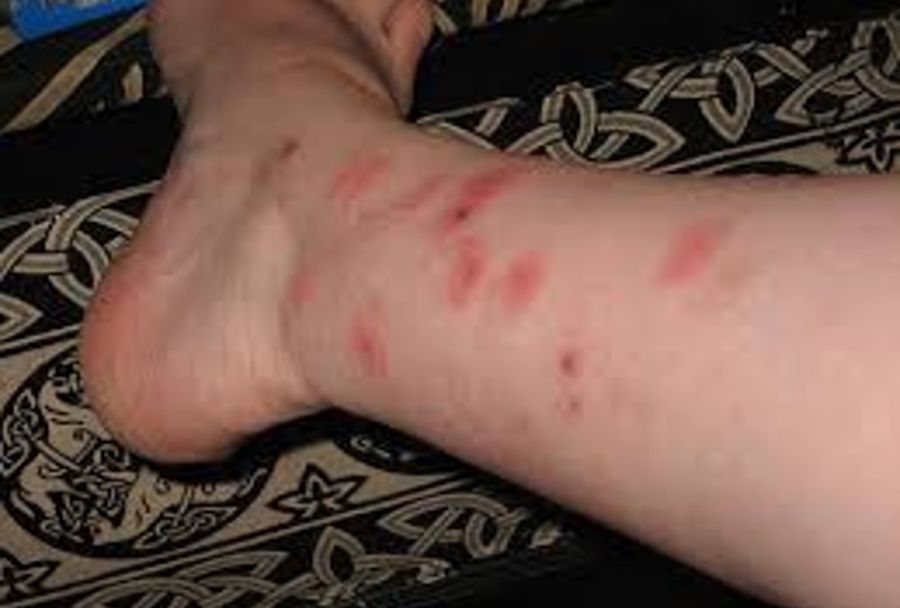 Bed bug bites on skin